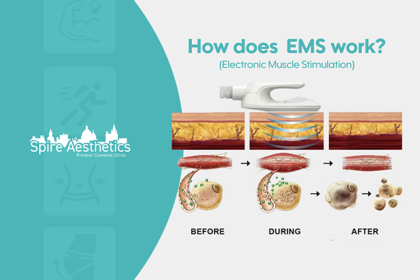 EMS treatment for post pregnancy weight loss treatment yorkshire