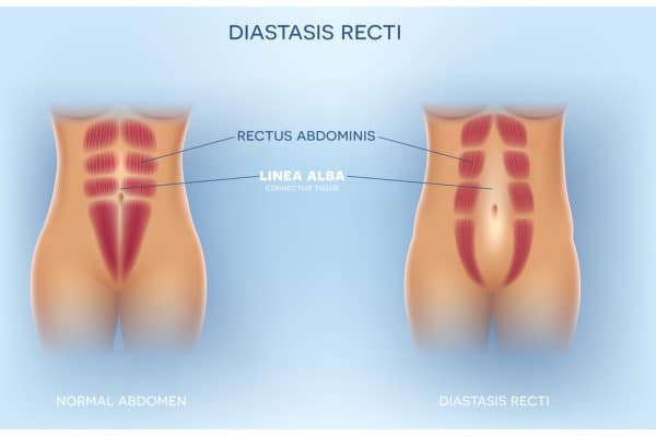 What Non-Surgical Options Are Available for Diastasis Recti yorkshire ?