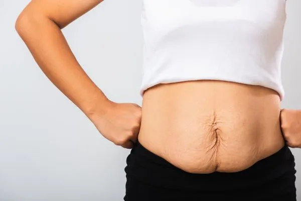 Image of a woman's stomach after weight loss with sagging skin following a gastric band yorkshire