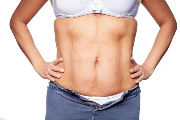 sagging skin on woman's stomach after weight loss injections yorkshire