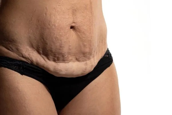 Image of womans stomach after weight loss injections yorkshire showing saggy skin