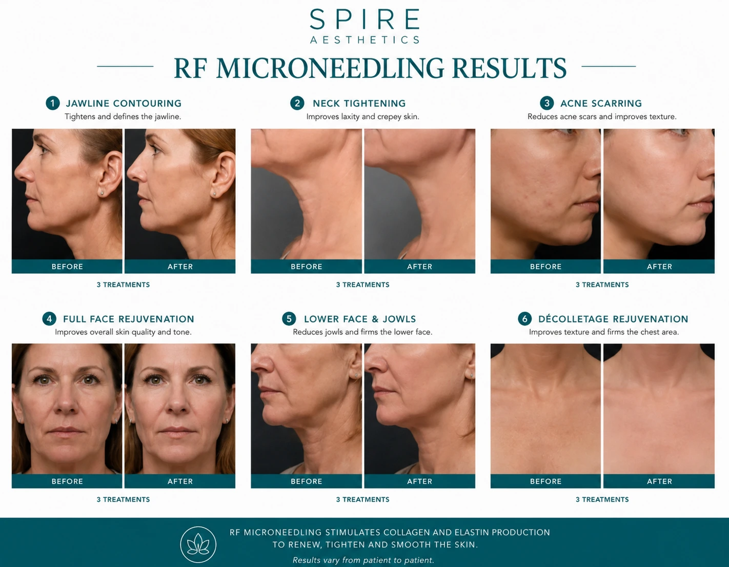 RF Microneedling Skin tightening yorkshire results