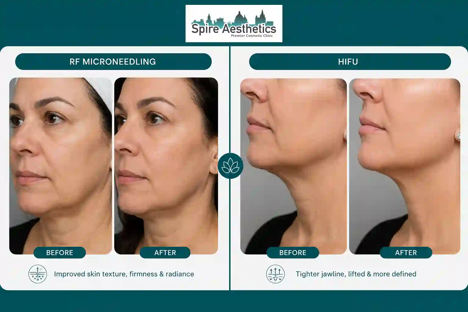 Can RF Microneedling and HIFU Be Combined yorkshire ?