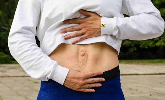 When Could Diastasis Recti Be the Missing Piece of the Puzzle yorkshire ?