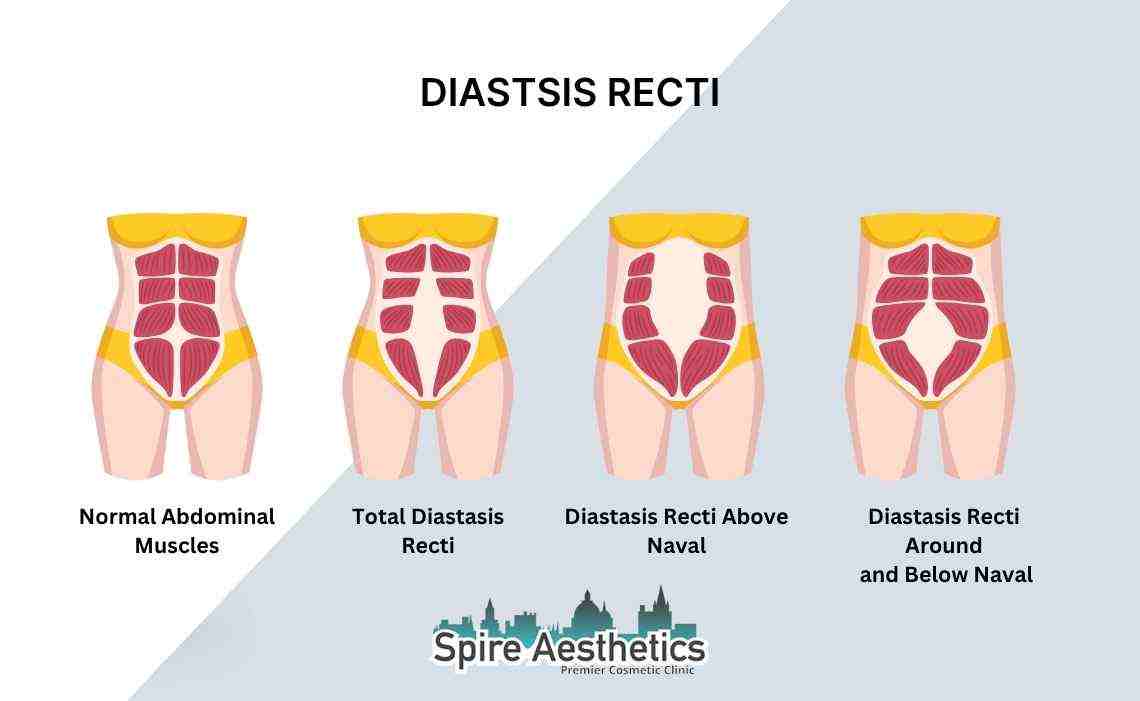 Is Non-Surgical Diastasis Recti Treatment Right for You? Common Concerns Answered yorkshire